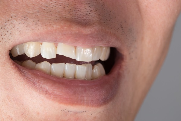 Why It Is Necessary To Repair A Chipped Tooth